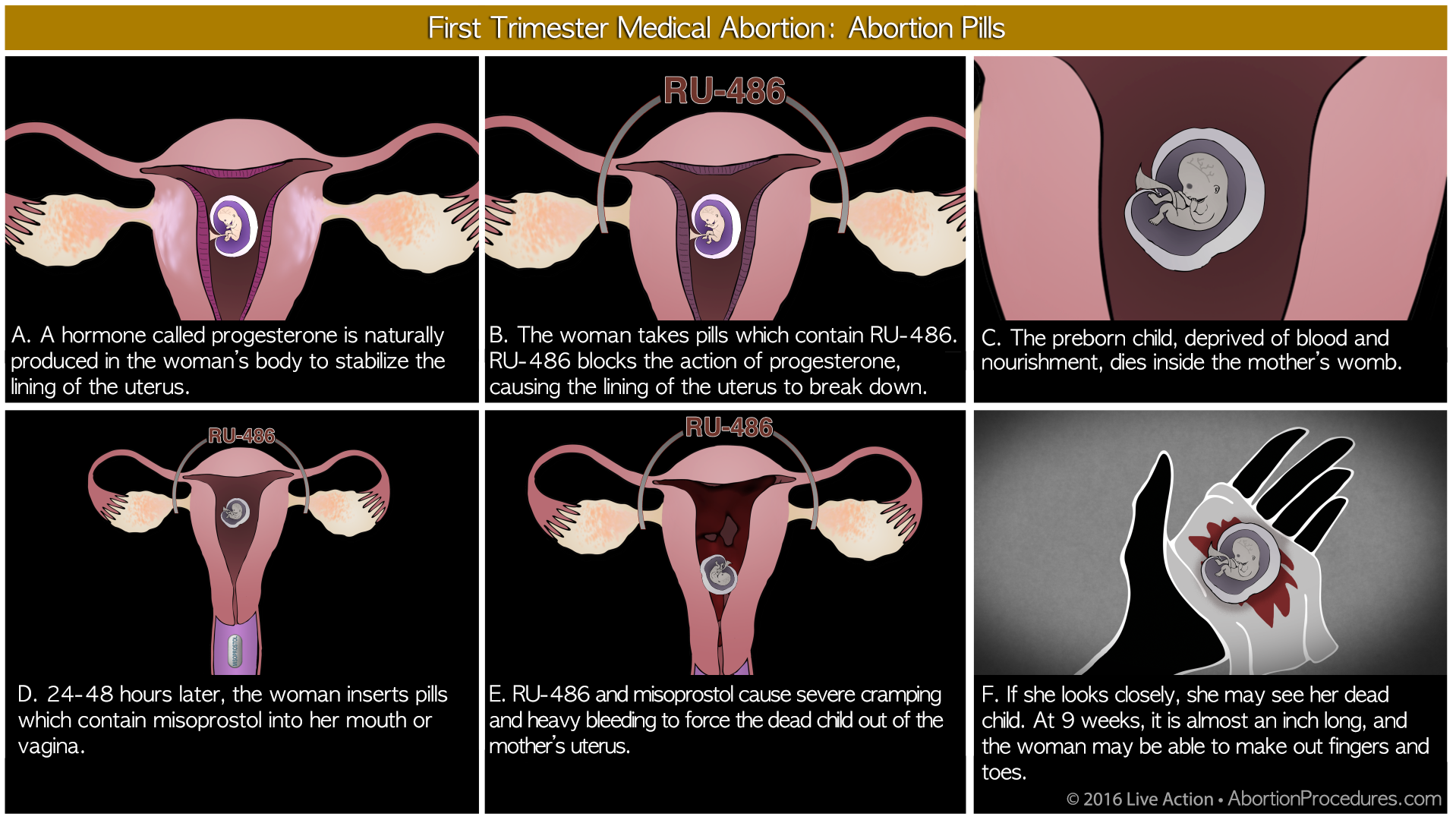 Medical abortion - six panel