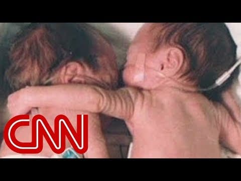 Thumbnail for The hug that helped change medicine