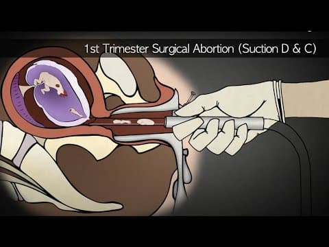 Thumbnail for Abortion Procedures 1st, 2nd, and 3rd Trimesters