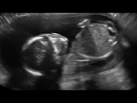 Thumbnail for Baby Punches Own Head In Ultrasound