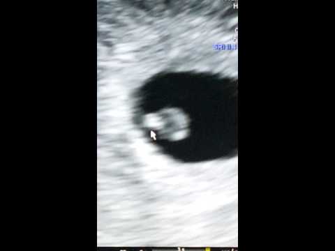 Thumbnail for 5 weeks 5 days - We see the 1st Heartbeats!!!