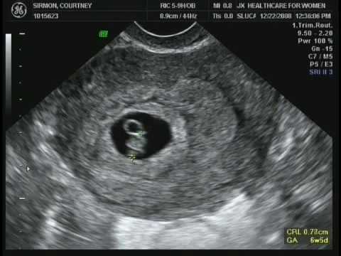 Thumbnail for 6 weeks 5 days ultrasound