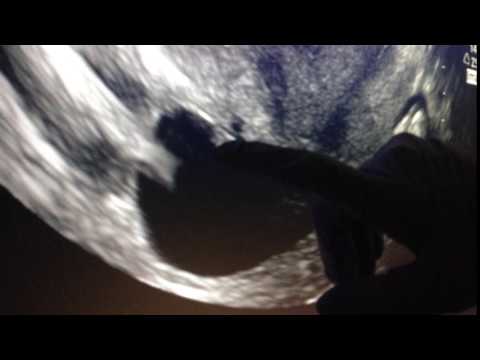 Thumbnail for 6 Week Ultrasound with Heartbeat!