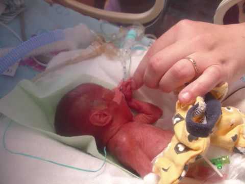 Thumbnail for Hunter & Darcy 22 week premature twins Survivors