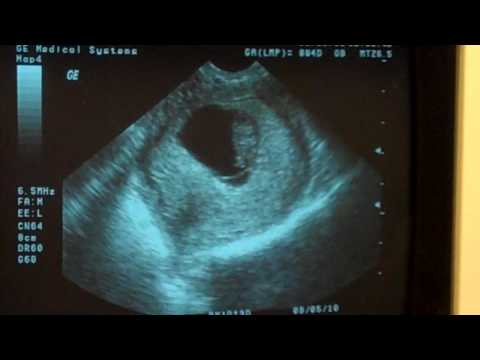 Thumbnail for A heartbeat 8 Weeks 1 Day Ultrasound