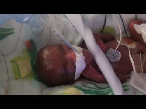 Thumbnail for World’s Smallest Baby Born in San Diego at Sharp Mary Birch Hospital