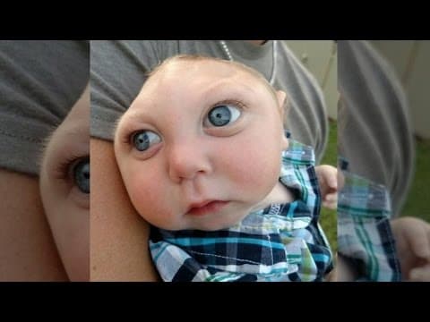 Thumbnail for Baby Born With Large Part of Skull Missing Adorably Says 'Hello'