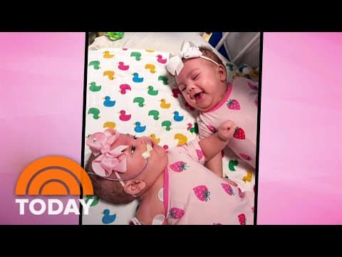 Thumbnail for Separated conjoined twins heading home after successful surgery