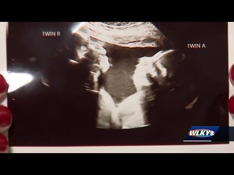 Thumbnail for Louisville woman pregnant with conjoined twins