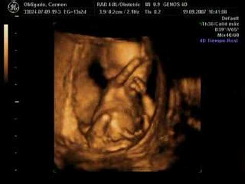 Thumbnail for My baby ultrasound 13 weeks