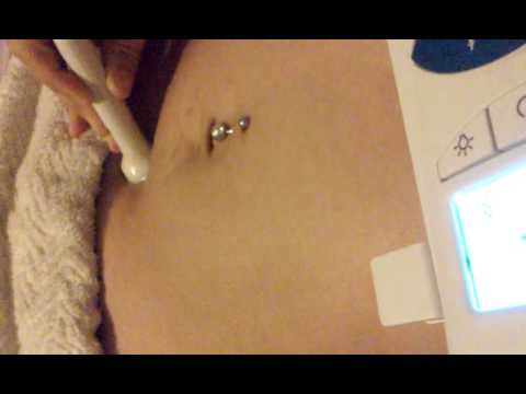 Thumbnail for 7 weeks 1 day fetal heartbeat