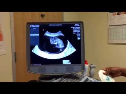 Thumbnail for 10 WEEKS PREGNANT! BABY KICKING UP A STORM!