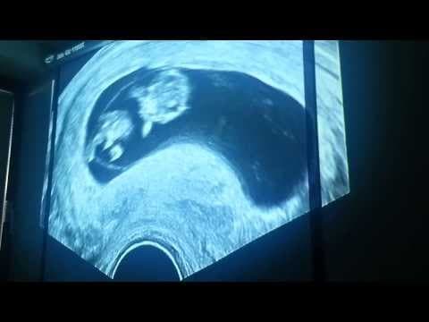 Thumbnail for 9 weeks 2 days ultrasound heartbeat