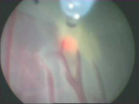 Thumbnail for Laser ablation surgery performed on identical twins with TTTS