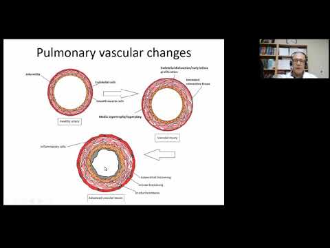 Thumbnail for Cardiac Surgery in Infants with Trisomy 18 and 13