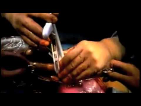 Thumbnail for Open fetal surgery