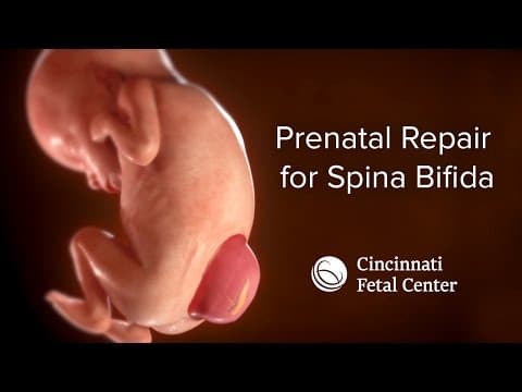 Thumbnail for Spina Bifida Medical Animation | Cincinnati Fetal Center
