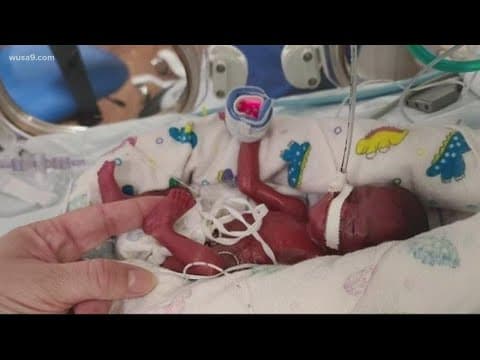 Thumbnail for Holy Cross Health treats smallest micro baby at NICU on record