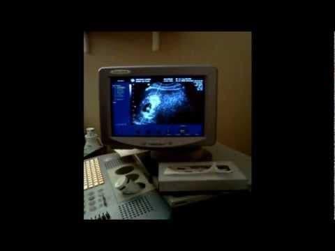 Thumbnail for 6 weeks Baby's First Heart Beat