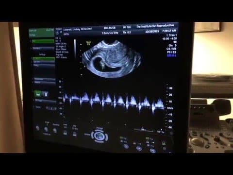 Thumbnail for 8 Weeks Pregnant Ultrasound Baby Heartbeat