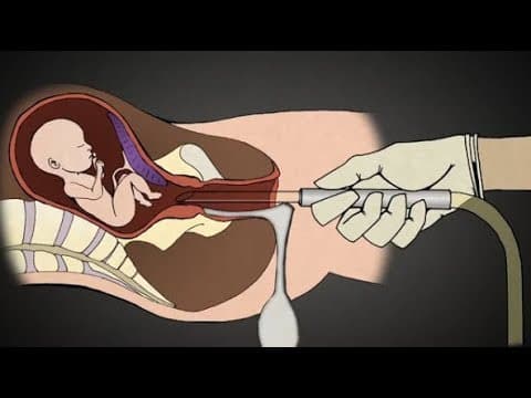 Thumbnail for The Reality of 2nd Trimester Surgical Abortions - Dr Norman MacLean NZOM