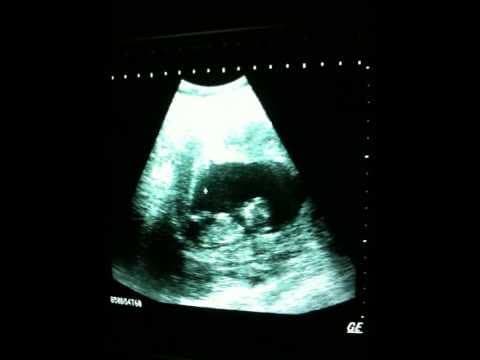 Thumbnail for baby playing in mother's womb !!!!!