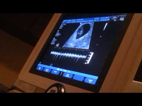 Thumbnail for Ultrasound my babys heartbeat @ 7 weeks