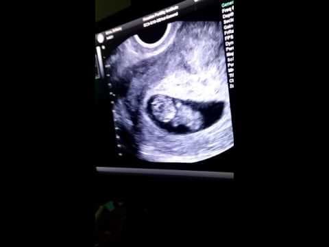 Thumbnail for 9 Weeks 4 Days Pregnant Ultrasound!