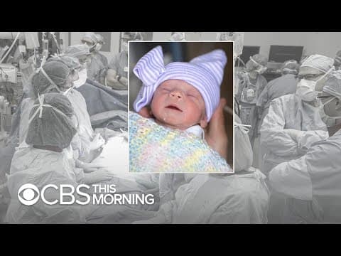 Thumbnail for Woman gives birth after receiving uterus transplant from a dead donor