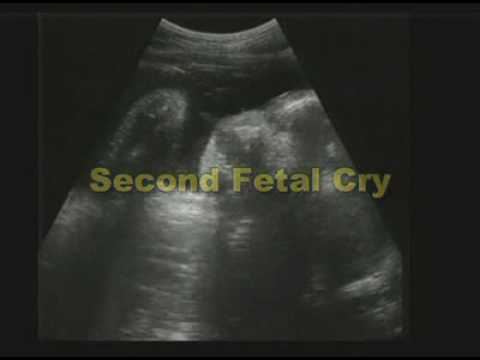 Thumbnail for Discovery Channel    Video    Baby Cries in Womb.swf