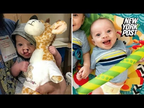 Thumbnail for Baby born with cleft lip gets a second chance to smile