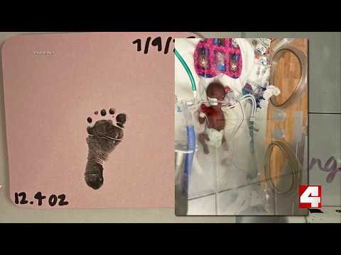 Thumbnail for Baby born in St. Louis weighing less than a pound comes home after a year in the hospital