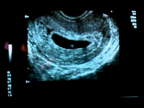 Thumbnail for 6 week ultrasound of Baby Parker with heartbeat!!