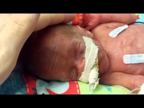 Thumbnail for Micro Preemie James Trying to Open His Eyes