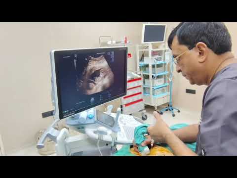 Thumbnail for Fetal reduction in TCTA with KCL