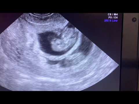 Thumbnail for fetal reduction under ultrasound guidance