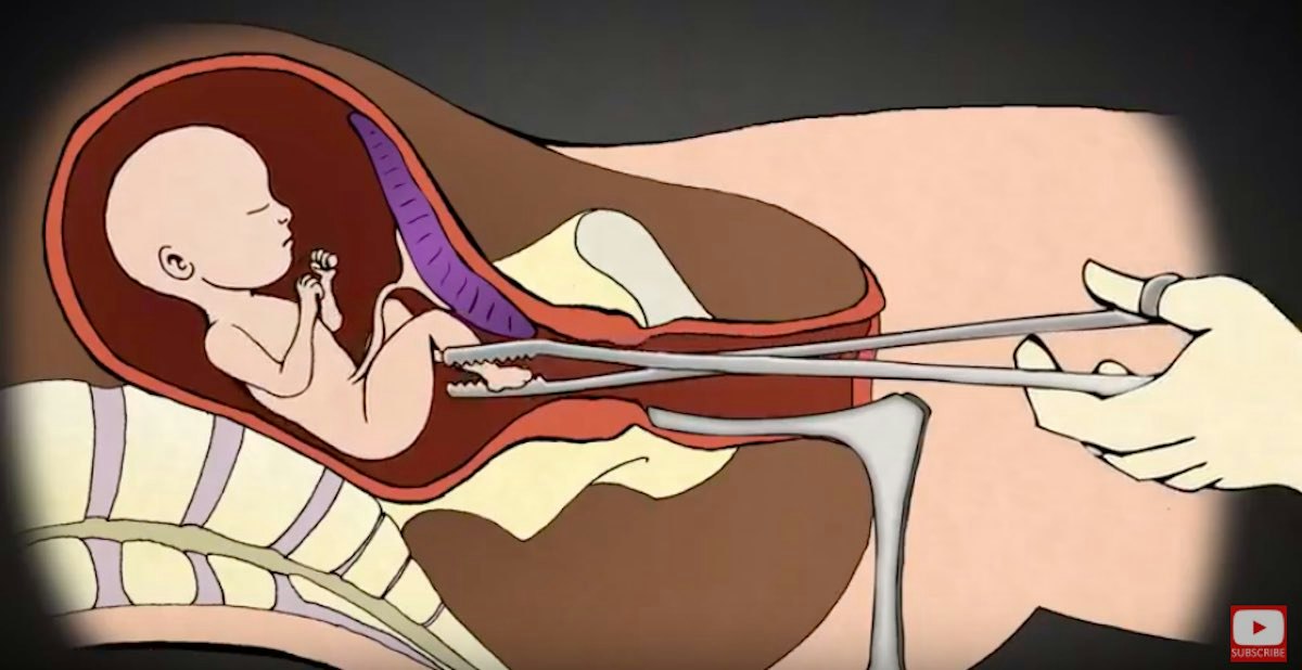 Explosive video reveals how UCSF dismembers preborn babies to obtain ...