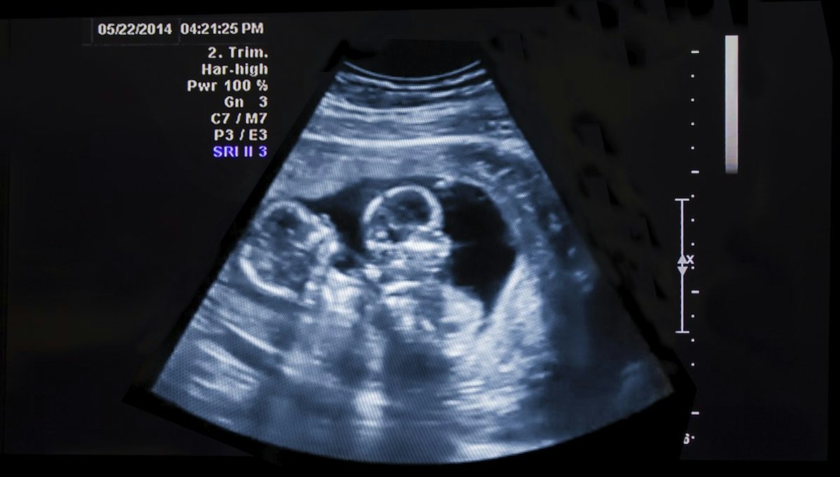 Rare condition causes woman to conceive another baby… while already ...