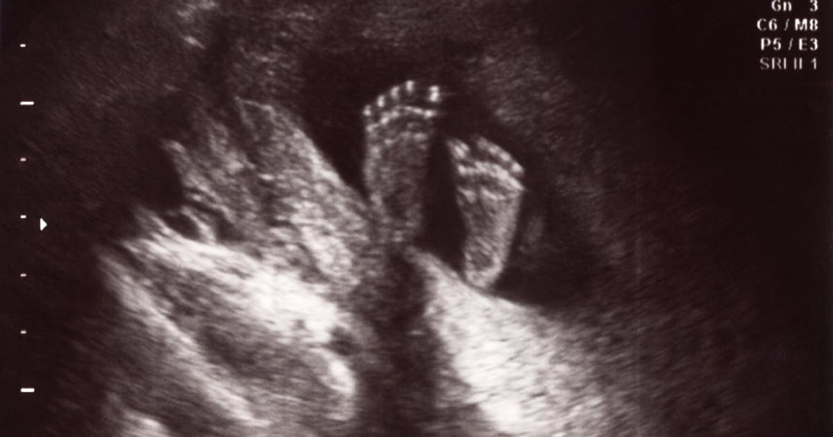 Reddit users convince couple not to abort after prenatal screening