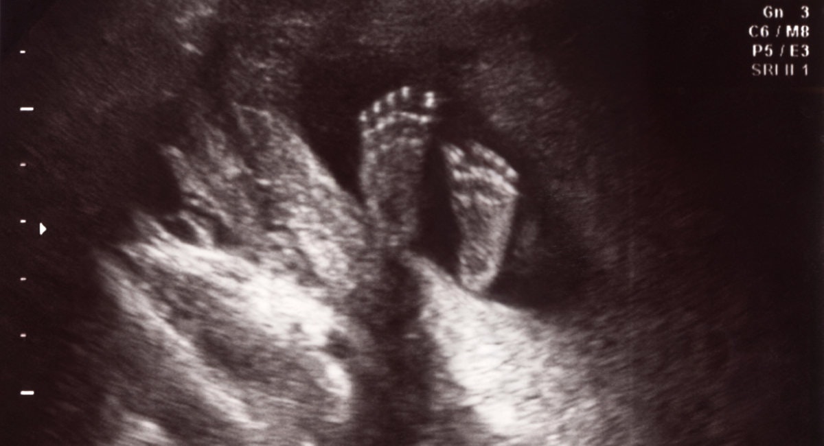 Reddit users convince couple not to abort after prenatal screening