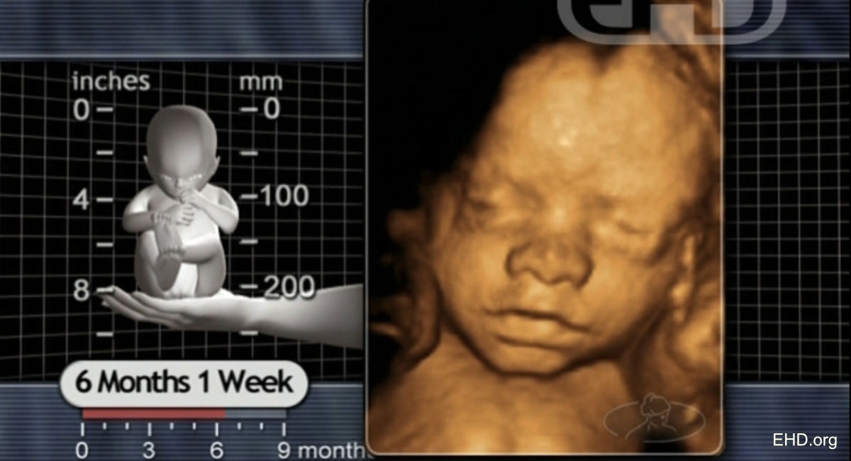 Groundbreaking in-utero surgery saves preborn baby from rare tumor