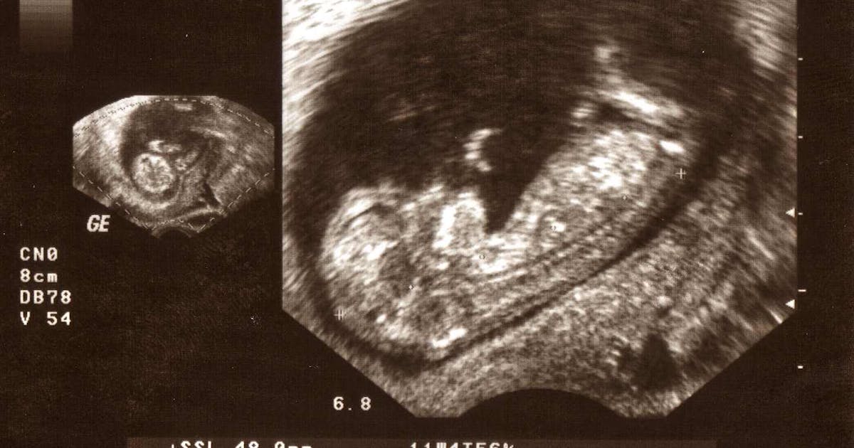 Since Roe, an estimated 66 million preborn babies have died by abortion