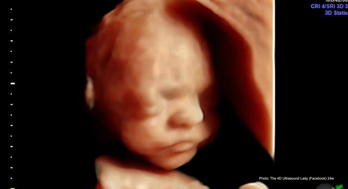 Abortionist call abortion after 24 weeks a 'labor of love'