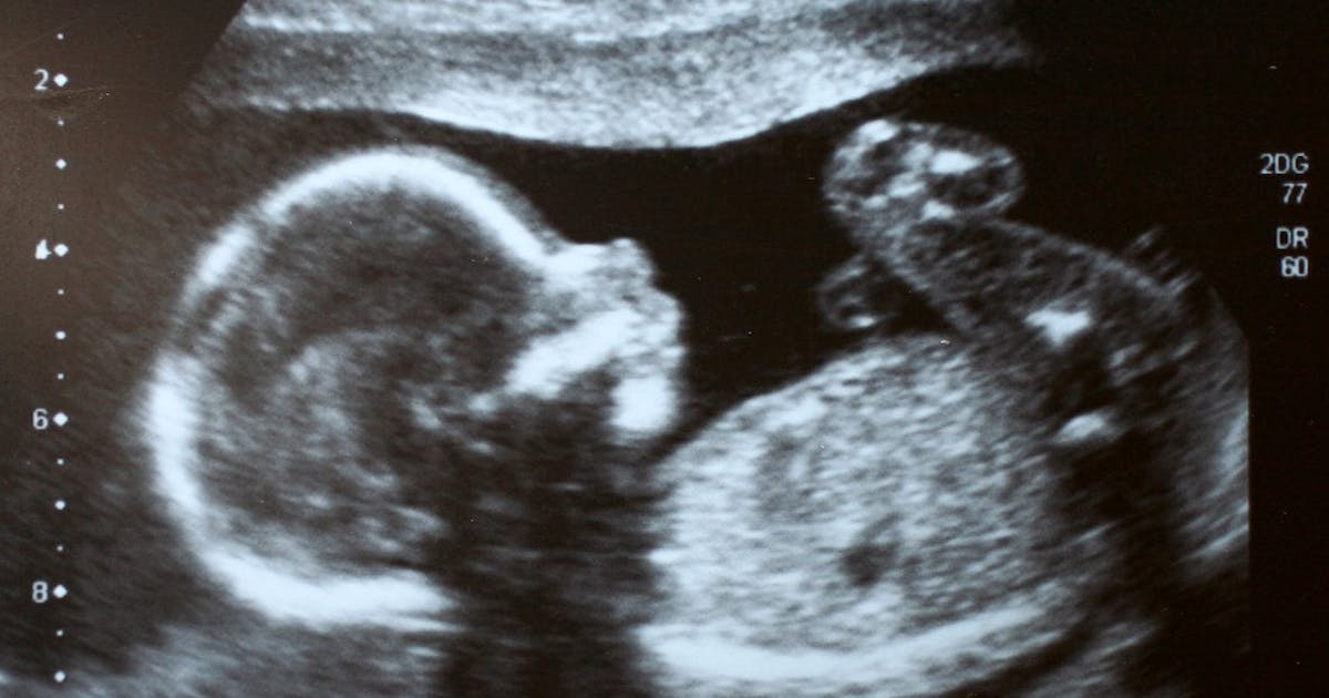 Study: Treatment could save lives of preborn babies with kidney condition