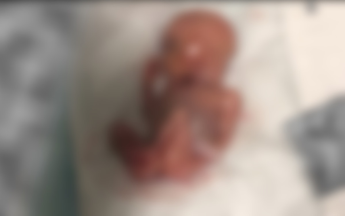 Distressing photo appears to show aborted baby sucking thumb while left to die