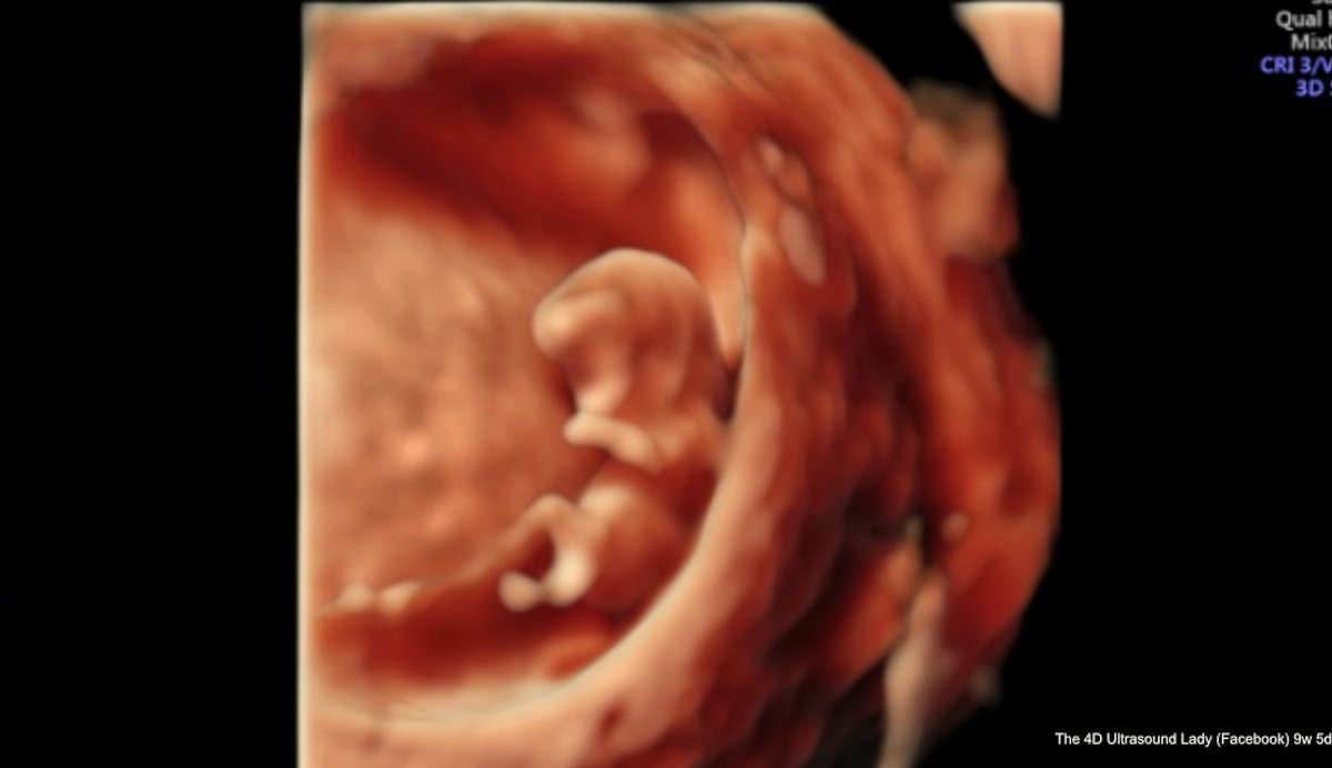 Big Abortion's 'Sleight of Hand' Tactics: Dehumanize humans not yet born