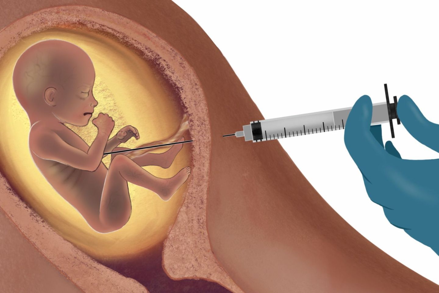 This isn't health care: Induction abortion vs. inducing labor and delivery