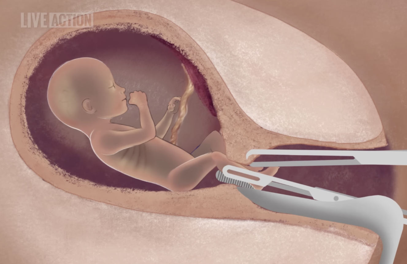 Dismemberment abortions happening later in pregnancy despite 'lack of clinical guidelines'