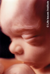 A 20-week-old baby, like the one aborted here.