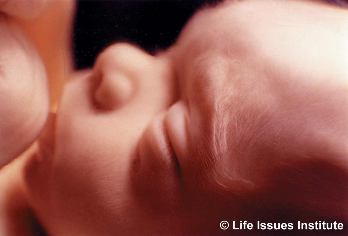 abortions,abortion, late-term, aborted, baby olivia, viability